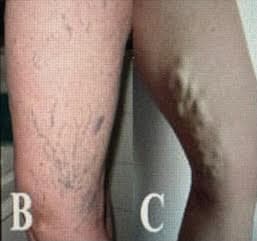 Comprendre les varices : causes, symptômes et prévention